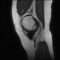Anterior cruciate ligament rupture and posteromedial corner injury (Radiopaedia 67338-76723 Sagittal PD 31).jpg