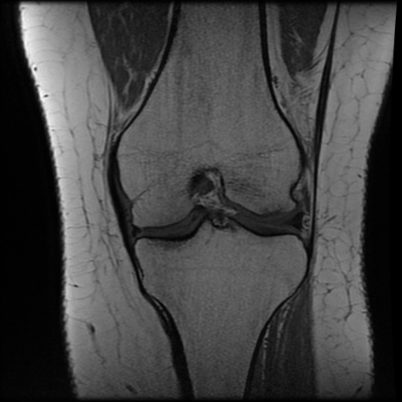 File:Anterior cruciate ligament tear, Wrisberg rip and bucket-handle tear of medial meniscus (Radiopaedia 75872-87266 Coronal T1 15).jpg