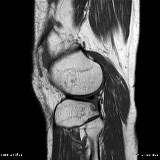File:Anterior cruciate ligament tear (Radiopaedia 70783-80964 Sagittal T1 24).jpg