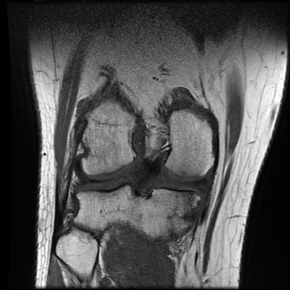 File:Anterior cruciate ligament tear with posteromedial corner injury, bucket-handle meniscal tear and chondral delamination (Radiopaedia 75501-86744 Coronal T1 18).jpg