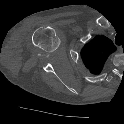 Anterior glenohumeral dislocation with Hill-Sachs lesion (Radiopaedia 62877-71249 Axial bone window 46).jpg