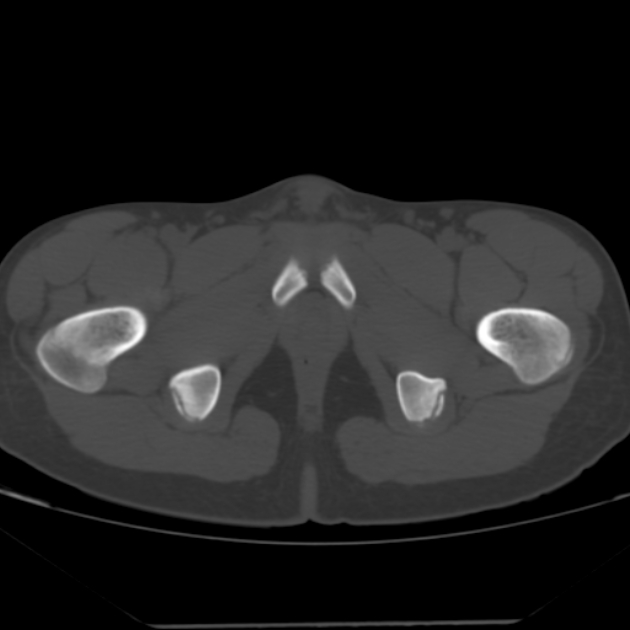 Anterior inferior iliac spine avulsion fracture (Radiopaedia 49469-54627 Axial bone window 53).jpg