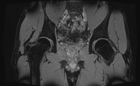Anterior inferior iliac spine avulsion fracture (Radiopaedia 81312-95000 G 39).jpg