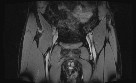 Anterior inferior iliac spine avulsion fracture (Radiopaedia 81312-95000 G 88).jpg