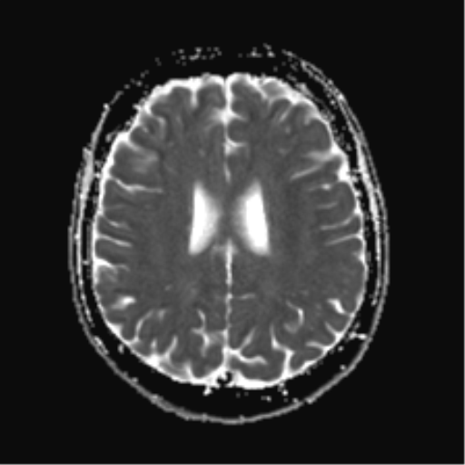 File:Anterior temporal lobe perivascular space (Radiopaedia 40946-43650 Axial ADC 18).png