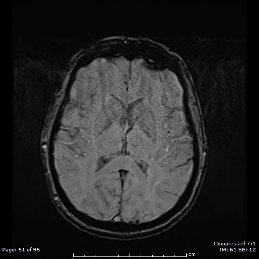 Anterior temporal lobe perivascular space (Radiopaedia 88283-104914 Axial SWI 30).jpg