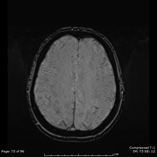 File:Anterior temporal lobe perivascular space (Radiopaedia 88283-104914 Axial SWI 44).jpg
