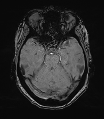Anterior temporal pole cysts (Radiopaedia 46629-51102 Axial SWI 32).png