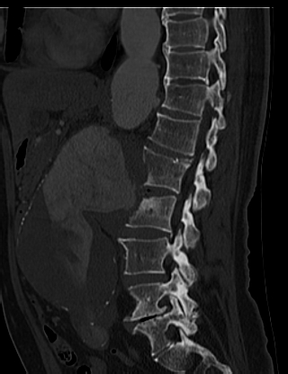 File:Anterior vertebral scalloping (abdominal aortic aneurysm) (Radiopaedia 66744-76067 Sagittal bone window 24).jpg
