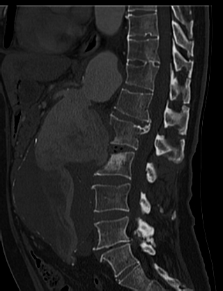 File:Anterior vertebral scalloping (abdominal aortic aneurysm) (Radiopaedia 66744-76067 Sagittal bone window 33).jpg