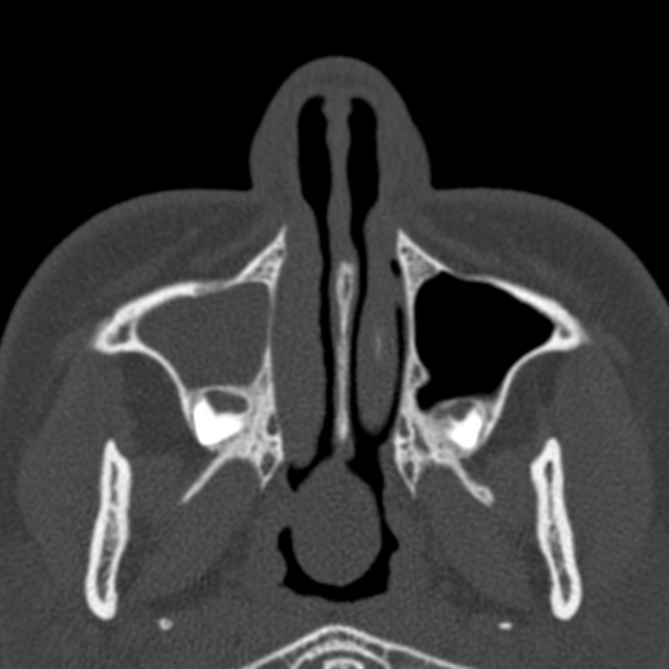 Antrochoanal polyp (Radiopaedia 33984-35202 Axial bone window 14).jpg