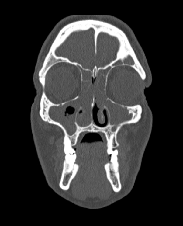Antrochoanal polyp (Radiopaedia 79011-92169 Coronal bone window 62).jpg