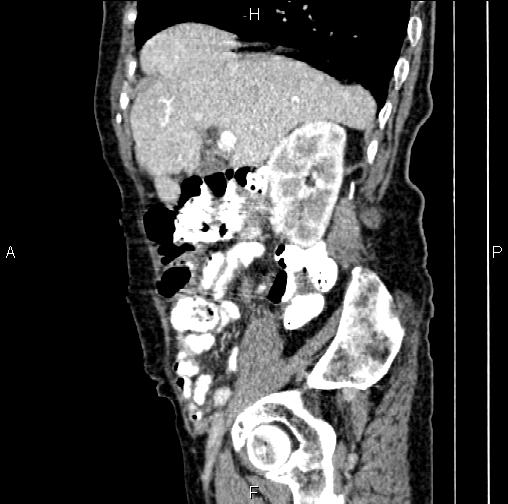 File:Aortic aneurysm and Lemmel syndrome (Radiopaedia 86499-102554 D 24).jpg