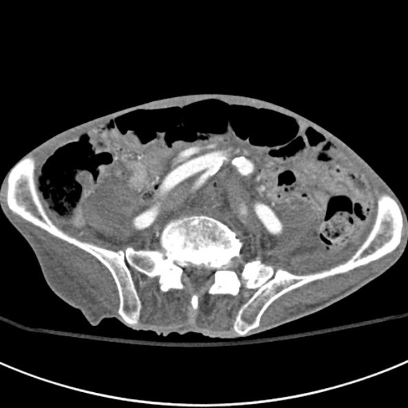 File:Aortic aneurysm with spinal destruction (Radiopaedia 42301-45410 A 74).jpg