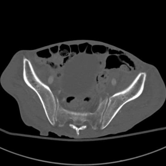 Aortic aneurysm with spinal destruction (Radiopaedia 42301-45410 Axial bone window 88).jpg