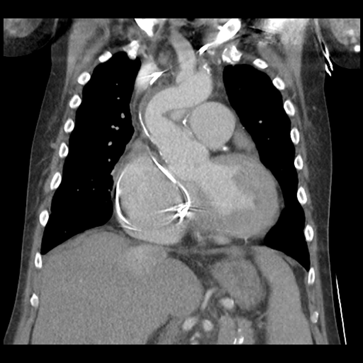 Aortic arch graft infection (FDG PET-CT) (Radiopaedia 71975-82437 Coronal 25).jpg