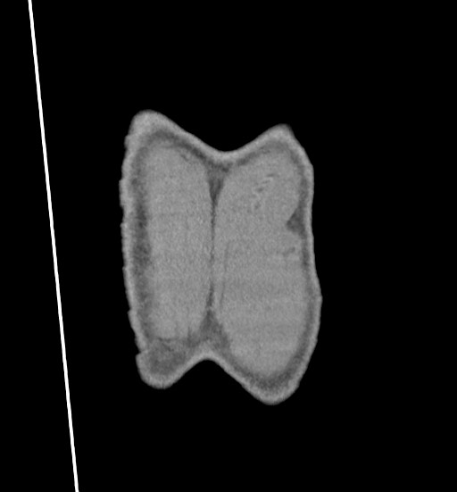 Aortic coarctation with aneurysm (Radiopaedia 74818-85828 C 119).jpg