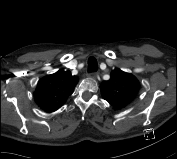 File:Aortic dissection (CTPA) (Radiopaedia 75506-86750 A 13).jpg
