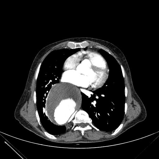 Aortic dissection (Radiopaedia 27466-27665 C+ arterial phase 165).jpg