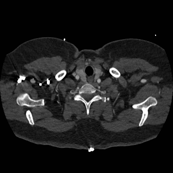 File:Aortic dissection (Radiopaedia 57969-64959 A 14).jpg