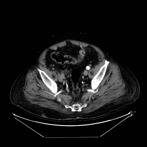 Aortic dissection (Radiopaedia 62562-71000 A 98).jpg
