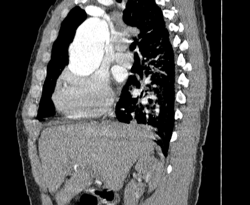 File:Aortic dissection - Stanford A -DeBakey I (Radiopaedia 28339-28587 C 1).jpg