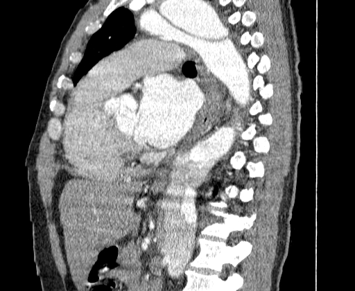 Aortic dissection - Stanford A -DeBakey I (Radiopaedia 28339-28587 C 41).jpg
