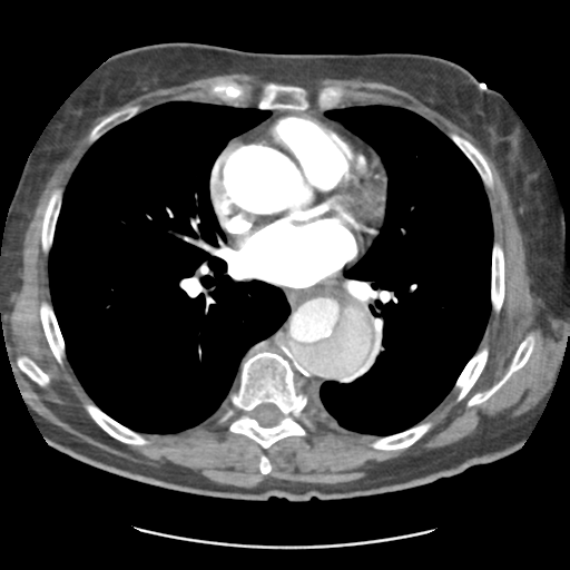 Aortic dissection - Stanford type B (Radiopaedia 50171-55512 A 28).png
