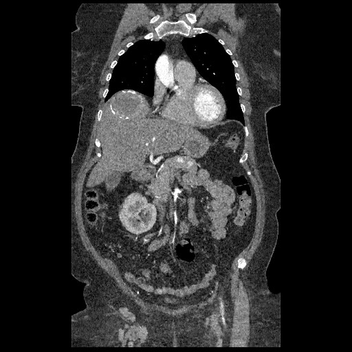 File:Aortic dissection - Stanford type B (Radiopaedia 88281-104910 B 16).jpg
