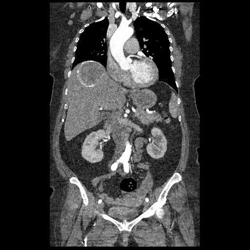 File:Aortic dissection - Stanford type B (Radiopaedia 88281-104910 B 28).jpg