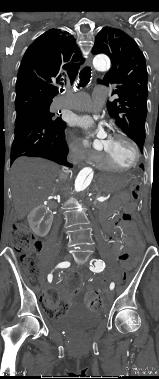 Aortic dissection with extension into aortic arch branches (Radiopaedia 64402-73204 A 39).jpg
