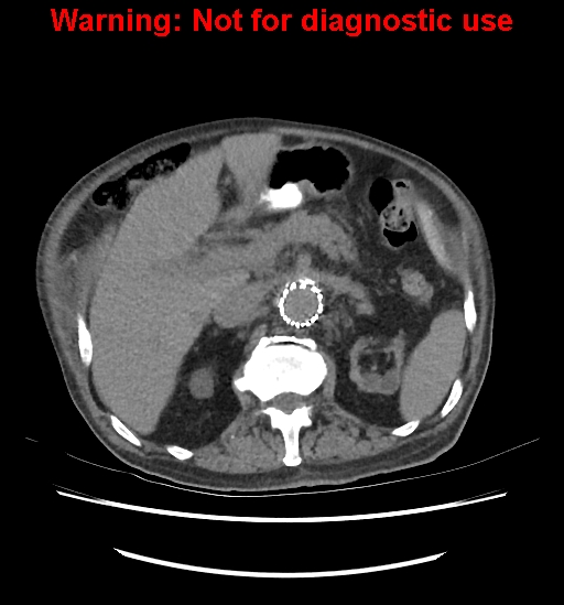 Aortic graft infection (Radiopaedia 44979-48907 Axial non-contrast 37).jpg