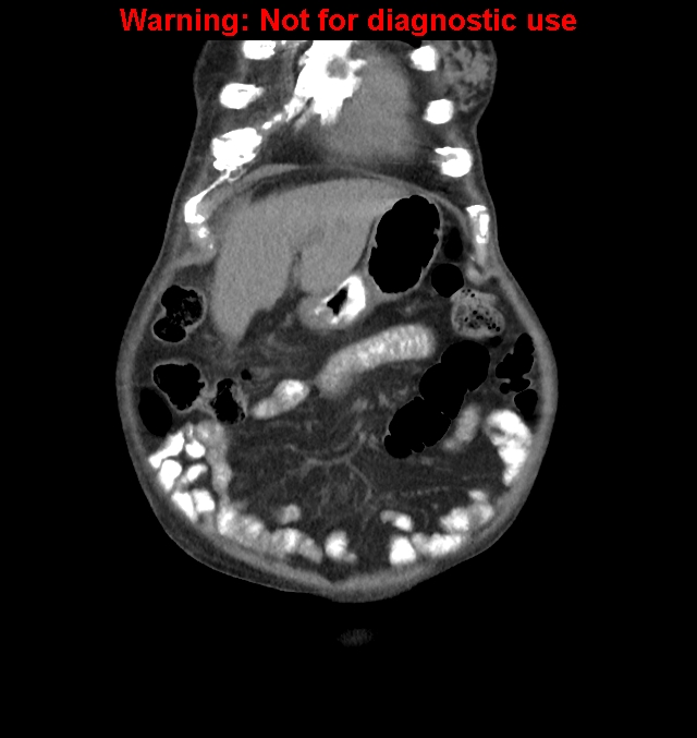Aortic graft infection (Radiopaedia 44979-48907 non-contrast 9).jpg