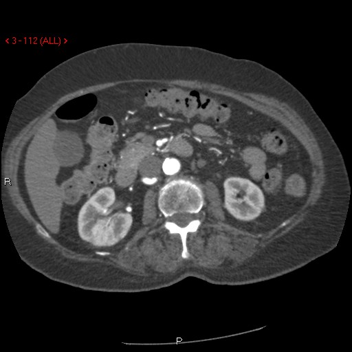Aortic intramural hematoma (Radiopaedia 27746-28001 A 112).jpg