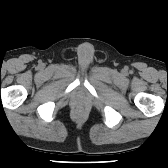 Aortic intramural hematoma (type B) (Radiopaedia 79323-92387 Axial non-contrast 120).jpg