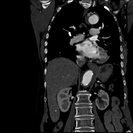 Aortic intramural hematoma from penetrating atherosclerotic ulcer (Radiopaedia 31137-31836 C 36).jpg