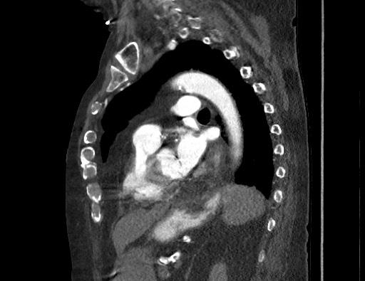 Aortoesophageal fistula with endovascular repair (Radiopaedia 73781-84592 Sagittal C+ CTPA 122).jpg