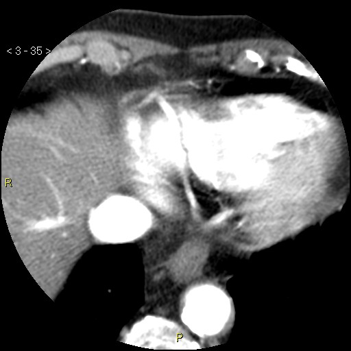 Aortoiliac occlusive disease (Radiopaedia 16828-16548 A 35).jpg