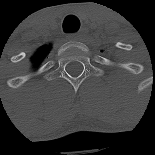File:Apical pneumothorax on cervical spine CT (Radiopaedia 45343-49368 Axial bone window 84).jpg