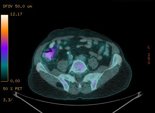 Appendiceal adenocarcinoma complicated by retroperitoneal abscess (Radiopaedia 58007-65041 Axial PET-CT 155).jpg