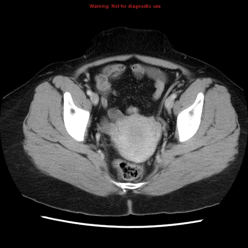 Appendiceal mucinous cystadenoma (Radiopaedia 8263-9111 Axial liver window 71).jpg