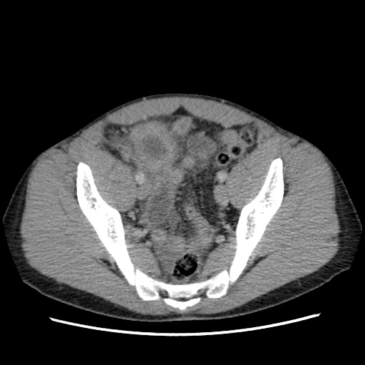 File:Appendicitis complicated by post-operative collection (Radiopaedia 35595-37114 A 71).jpg