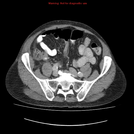 File:Appendicitis mass in inguinal hernia (Radiopaedia 26858-27029 A 8).jpg