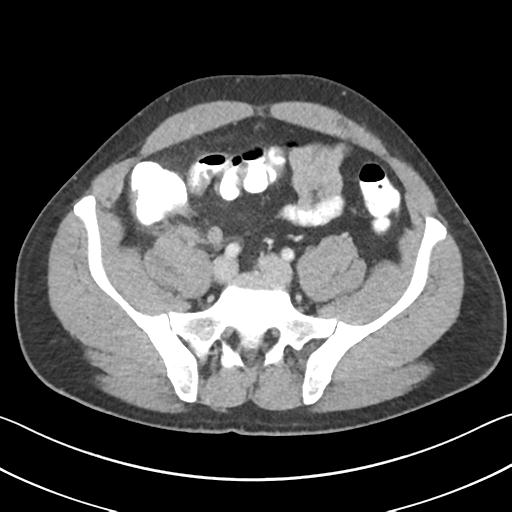 Appendicitis with cecal bar sign (Radiopaedia 31878-32830 B 58).jpg