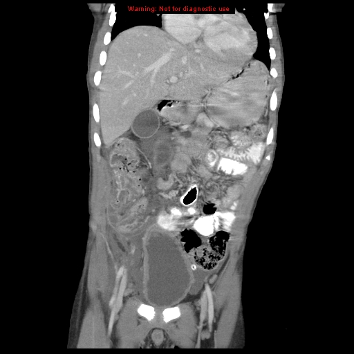 File:Appendicitis with phlegmon (Radiopaedia 9358-10046 B 23).jpg
