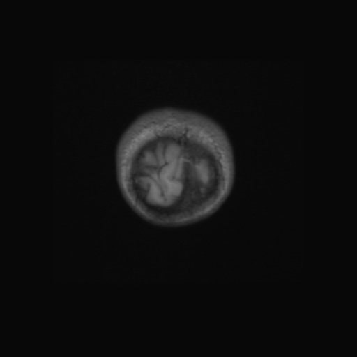 Aqueduct stenosis (Radiopaedia 52453-58460 Coronal T1 2).jpg