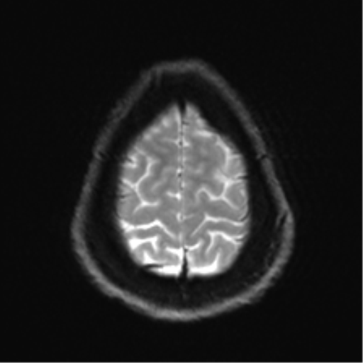 Arachnoid cyst - cerebellopontine angle (Radiopaedia 59689-67083 Axial DWI 32).png