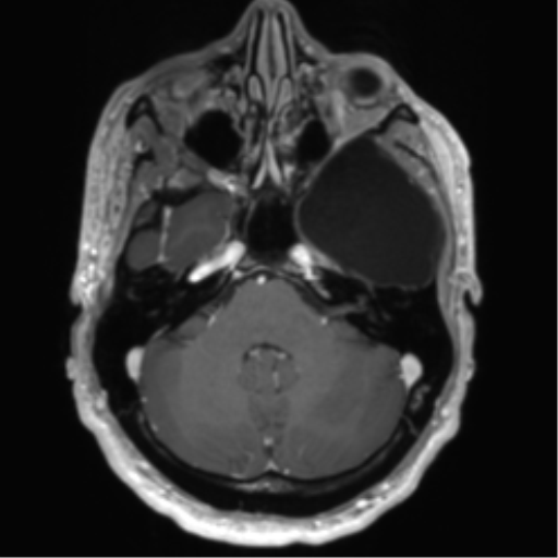 Arachnoid cyst with subdural hematoma (Radiopaedia 85892-101743 Axial T1 C+ 24).png