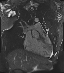 Arrhythmogenic right ventricular cardiomyopathy (Radiopaedia 57972-64966 CINE R2 SSFP 15).jpg