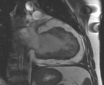 Arrhythmogenic right ventricular cardiomyopathy (Radiopaedia 69431-79307 2ch cine 25).jpg